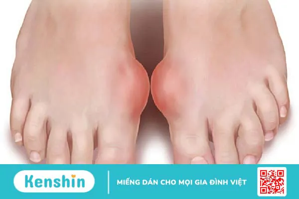 Những phương pháp điều trị bệnh gout hiệu quả