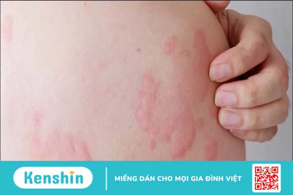 Nổi mề đay kiêng gì? Nên ăn gì và lưu ý giúp giảm ngứa, mau lành