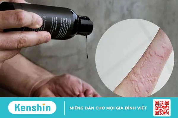 Nổi mề đay kiêng gì? Nên ăn gì và lưu ý giúp giảm ngứa, mau lành