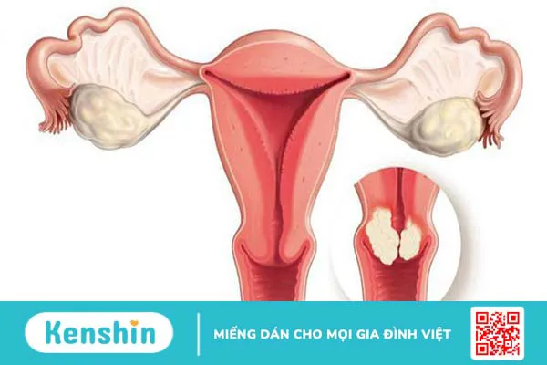 Nước tiểu đục là bệnh gì? Nguyên nhân và dấu hiệu bạn nên cảnh giác