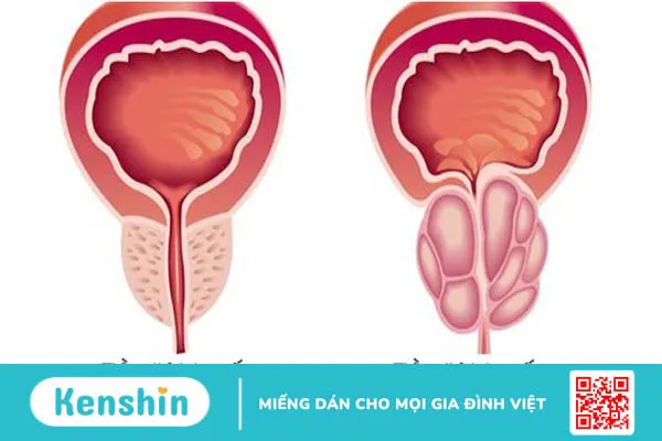 Nước tiểu đục là bệnh gì? Nguyên nhân và dấu hiệu bạn nên cảnh giác