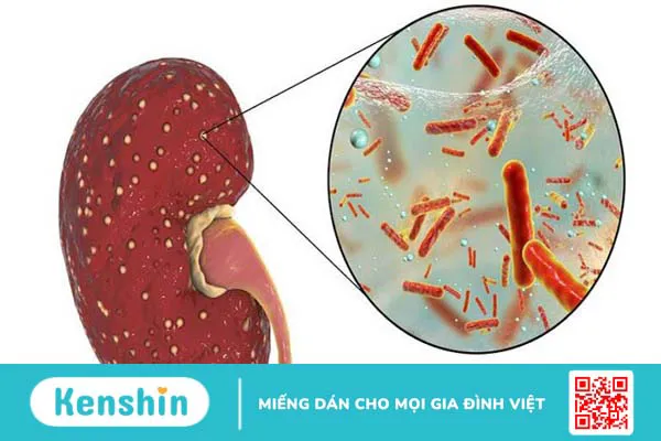 Nước tiểu đục là bệnh gì? Nguyên nhân và dấu hiệu bạn nên cảnh giác