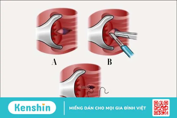 Nứt kẽ hậu môn có tự khỏi được không? Các cách điều trị nứt kẽ hậu môn