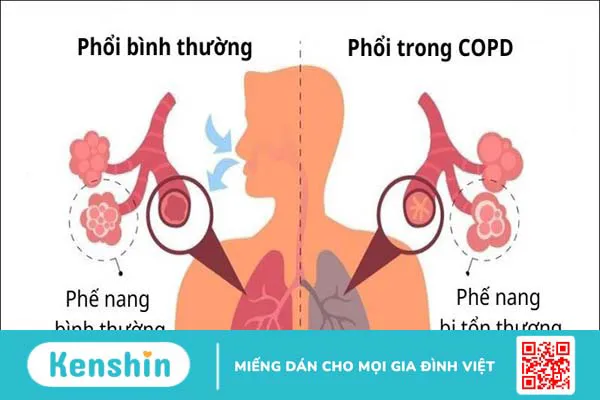 Omega 6 là gì? Tác dụng, cách dùng, tác dụng phụ, thực phẩm chứa omega 6