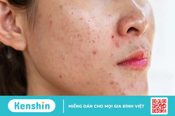 Peel da có tốt không? 11 tác dụng, lưu ý hiện tượng sau khi peel da