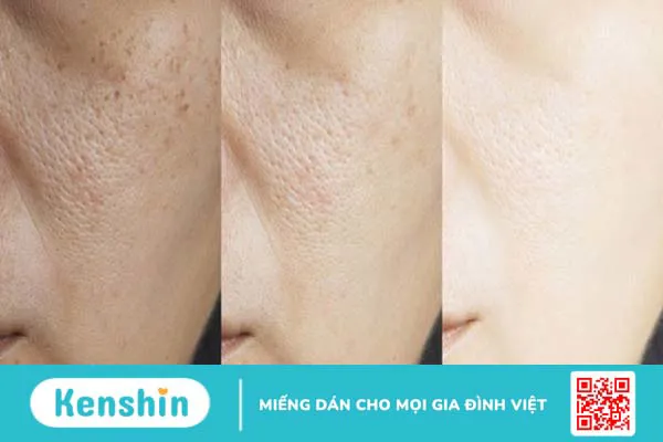 Peel da có tốt không? 11 tác dụng, lưu ý hiện tượng sau khi peel da