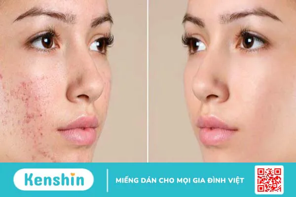 Peel da có tốt không? 11 tác dụng, lưu ý hiện tượng sau khi peel da