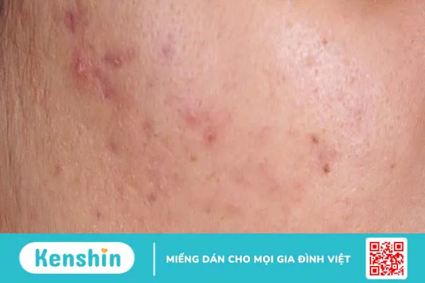 Peel da có tốt không? 11 tác dụng, lưu ý hiện tượng sau khi peel da