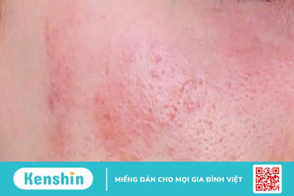 Phân biệt điểm khác nhau giữa Retinol và Tretinoin