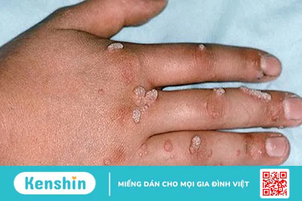 Phân biệt mụn cóc và sùi mào gà? Cách điều trị hiệu quả