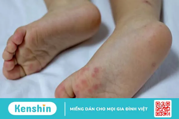 Phân biệt tay chân miệng và bệnh tương tự, các biện pháp phòng ngừa