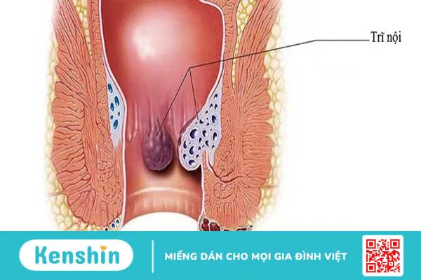 Phân biệt trĩ nội và trĩ ngoại