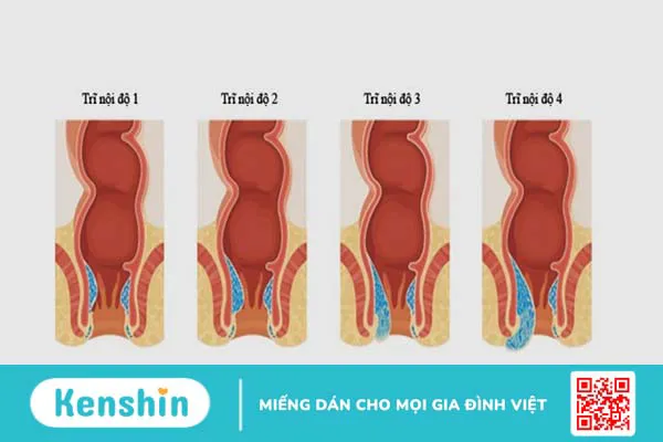 Phân biệt trĩ nội và trĩ ngoại