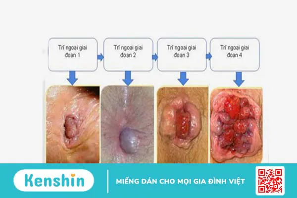 Phân biệt trĩ nội và trĩ ngoại