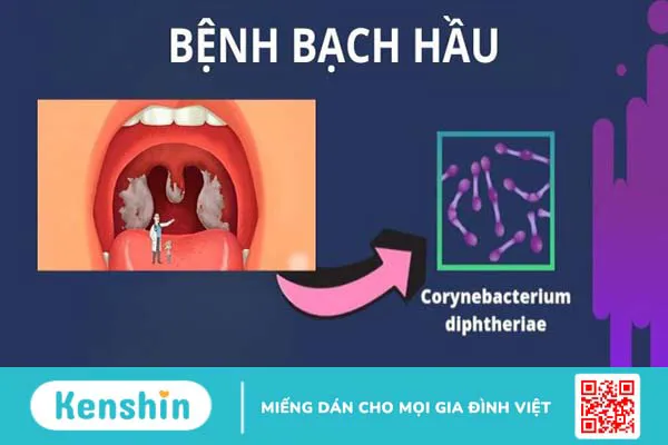 Phân biệt triệu chứng bạch hầu và viêm họng như thế nào?