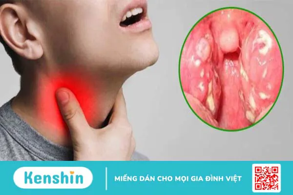 Phân biệt triệu chứng bạch hầu và viêm họng như thế nào?