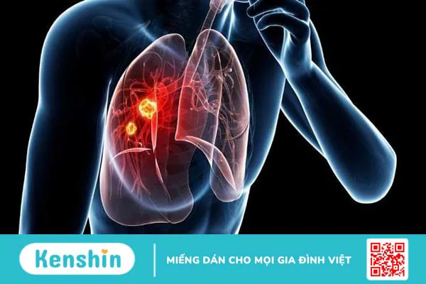 Phân biệt viêm họng và ung thư vòm họng qua 6 điều sau