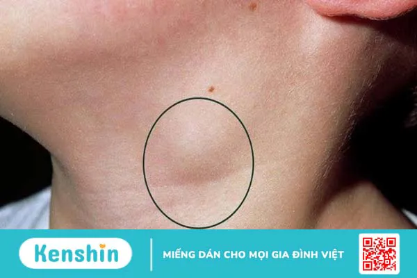 Phân biệt viêm họng và ung thư vòm họng qua 6 điều sau