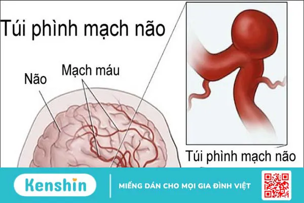 Phương pháp điều trị đột quỵ xuất huyết não bạn nên biết