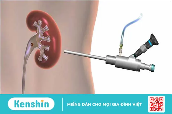 Phương pháp điều trị sỏi niệu quản bạn không nên bỏ qua