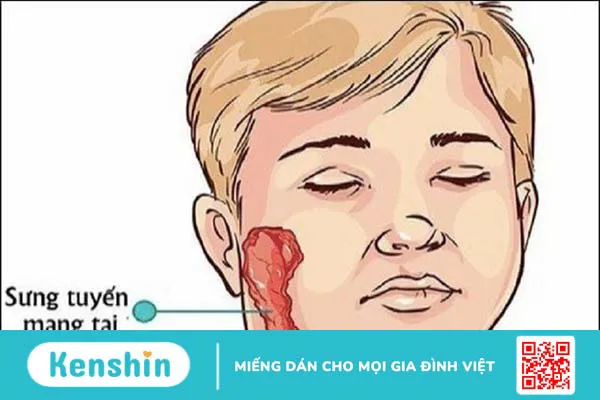 Quai bị có lây không? 4 nguy cơ lây nhiễm và biện pháp phòng ngừa