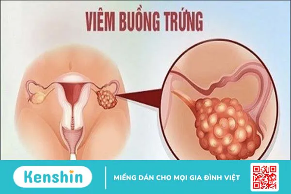 Quai bị có lây không? 4 nguy cơ lây nhiễm và biện pháp phòng ngừa