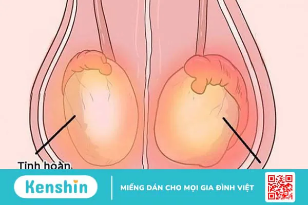 Quai bị có lây không? 4 nguy cơ lây nhiễm và biện pháp phòng ngừa