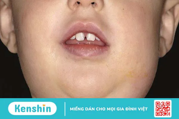 Quai bị có lây không? 4 nguy cơ lây nhiễm và biện pháp phòng ngừa