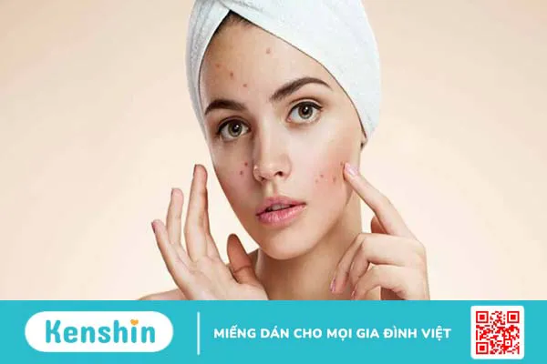 Quy trình chăm sóc da mụn tại nhà đơn giản, hiệu quả