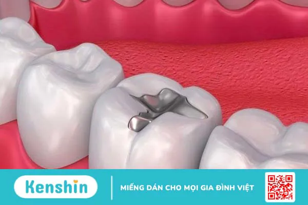 Răng trám bị nhức do đâu? 6 nguyên nhân thường gặp và cách điều trị hiệu quả