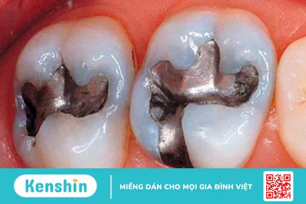 Răng trám bị nhức do đâu? 6 nguyên nhân thường gặp và cách điều trị hiệu quả