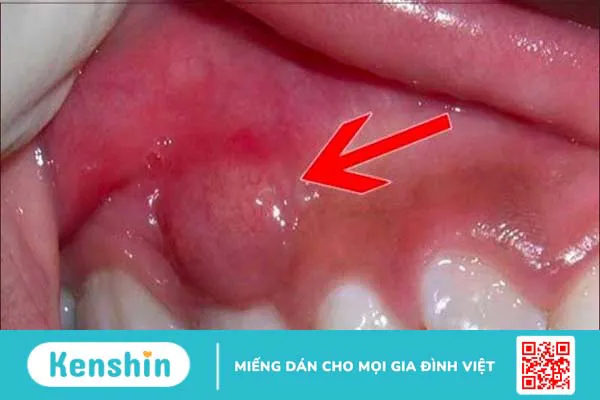 Răng trám bị nhức do đâu? 6 nguyên nhân thường gặp và cách điều trị hiệu quả