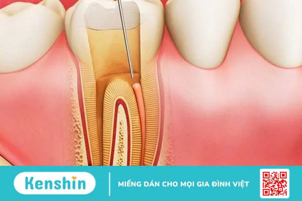 Răng trám bị nhức do đâu? 6 nguyên nhân thường gặp và cách điều trị hiệu quả