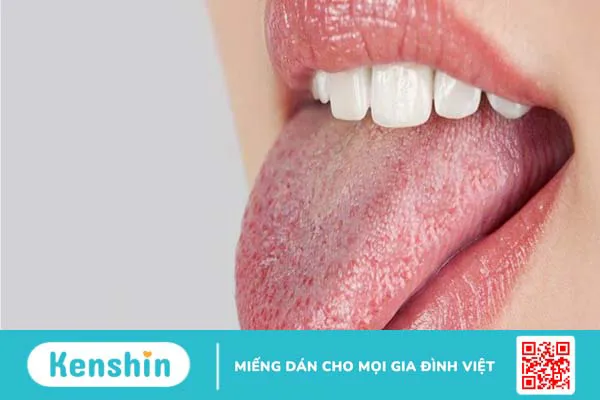 Rát lưỡi là bệnh gì? 5 nguyên nhân gây rát lưỡi, khô miệng kéo dài