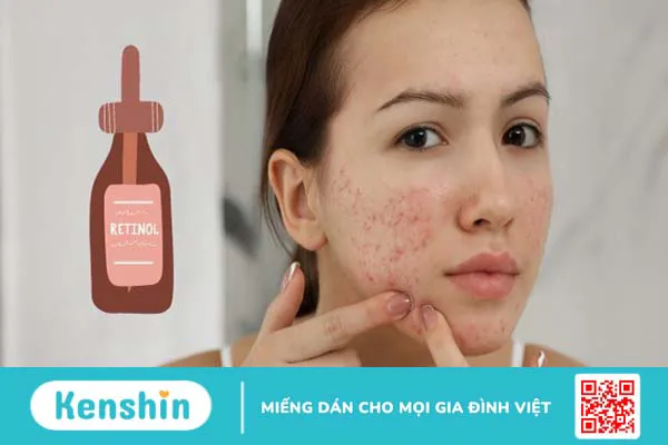 Retinol có thể trị mụn trứng cá không? Cách sử dụng retinol trị mụn đúng cách, an toàn