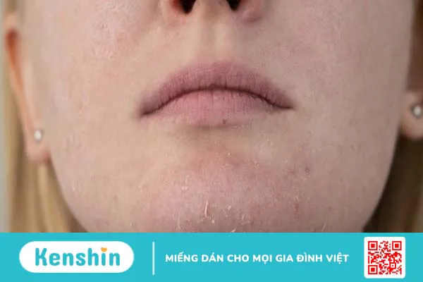 Retinol có thể trị mụn trứng cá không? Cách sử dụng retinol trị mụn đúng cách, an toàn