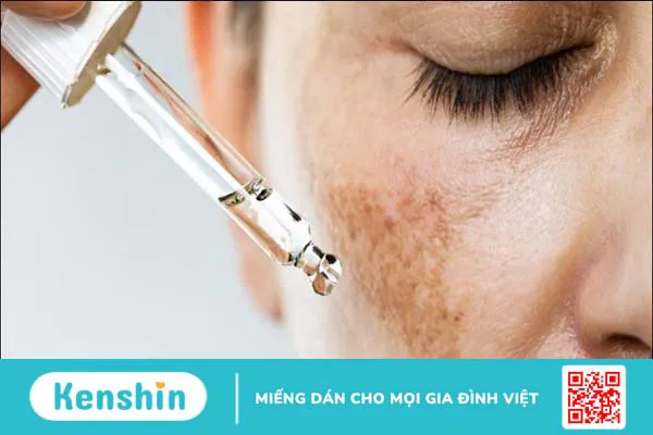 Retinol có thể trị mụn trứng cá không? Cách sử dụng retinol trị mụn đúng cách, an toàn