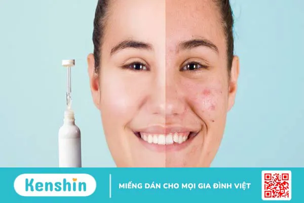 Retinol có thể trị mụn trứng cá không? Cách sử dụng retinol trị mụn đúng cách, an toàn