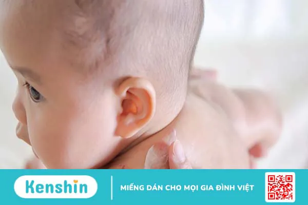 Rôm sảy là bệnh gì? Nguyên nhân, triệu chứng và cách điều trị