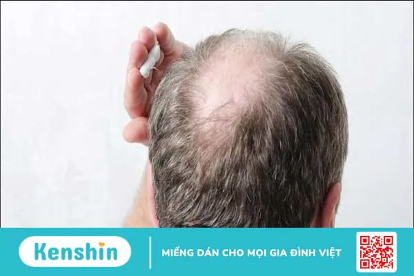 Rụng tóc ở nam giới do đâu? 11 nguyên nhân rụng tóc ở nam