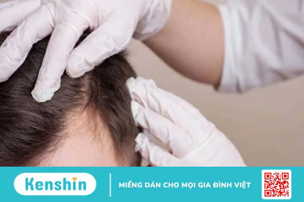 Rụng tóc ở nam giới do đâu? 11 nguyên nhân rụng tóc ở nam