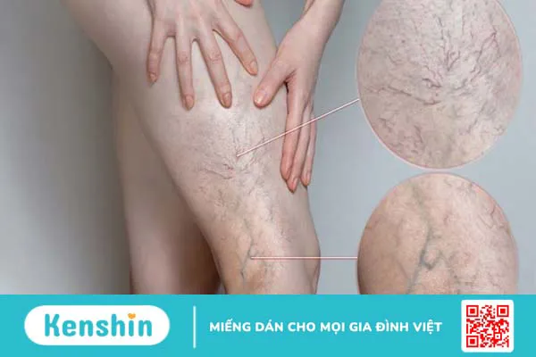 Rutin: Tác dụng, cách dùng, tác dụng phụ, thực phẩm chứa rutin