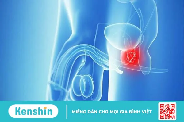 Saw Palmetto có ảnh hưởng đến Testosterone không?