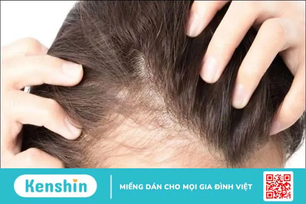 Saw Palmetto có ảnh hưởng đến Testosterone không?