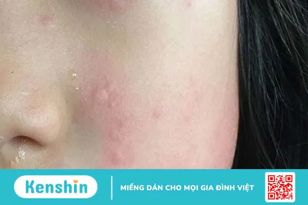 Serum Vitamin C có tác dụng gì với da mặt? Lưu ý khi dùng vitamin C