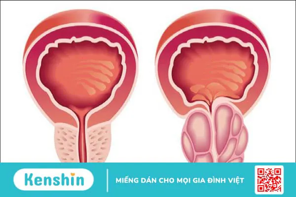 Sỏi bàng quang: 11 nguyên nhân gây bệnh không thể chủ quan