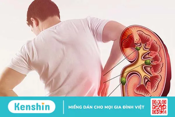 Sỏi bàng quang: 11 nguyên nhân gây bệnh không thể chủ quan