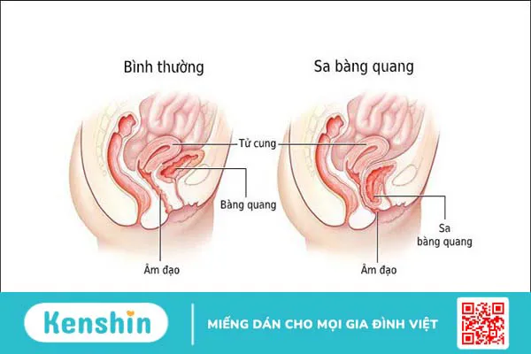 Sỏi bàng quang: 11 nguyên nhân gây bệnh không thể chủ quan