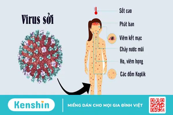 Sởi có lây không, lây qua đường nào? Cách phòng ngừa bệnh sởi hiệu quả