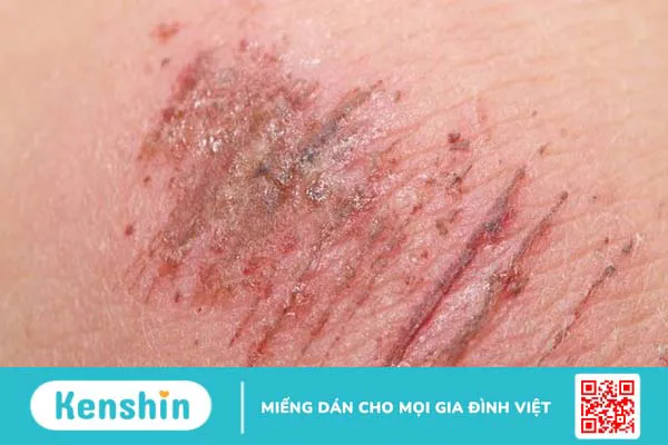 Sốt siêu vi có lây không? Sốt siêu vi lây qua đường nào?